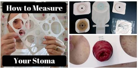 stoma tips